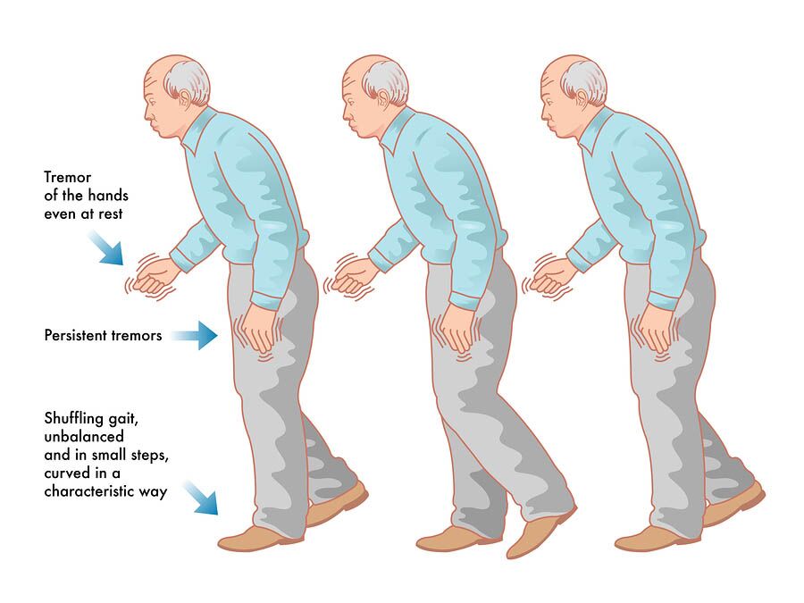Early Signs of Parkinson’s Disease